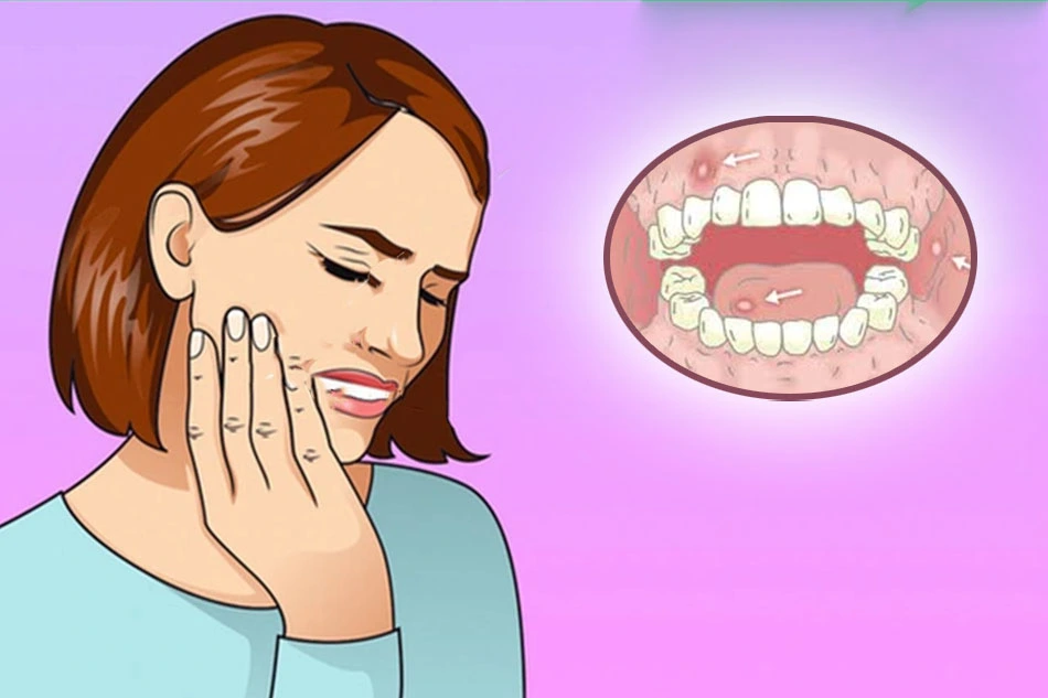 Top 10 cách chữa nhiệt miệng nhanh chóng và hiệu quả nhất